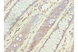 Immunohistochemistry of paraffin-embedded human colon cancer using ABIN7176126 at dilution of 1:100 (ZNF169 anticorps  (AA 1-85))