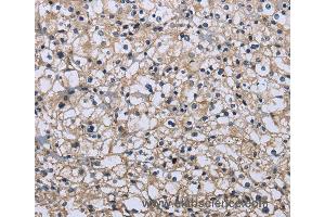 Immunohistochemistry of Human prostate cancer using MAPRE3 Polyclonal Antibody at dilution of 1:20 (MAPRE3 anticorps)