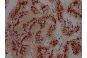IHC image of ABIN7127438 diluted at 1:100 and staining in paraffin-embedded human prostate cancer performed on a Leica BondTM system. (Recombinant Cullin 3 anticorps)
