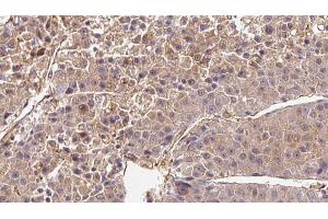 ABIN6272720 at 1/100 staining Human liver cancer tissue by IHC-P. (OR2B6 anticorps  (Internal Region))