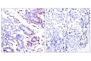 Immunohistochemical analysis of paraffin-embedded human breast carcinoma tissue using STAT1 (Ab-701) antibody (E021044). (STAT1 anticorps)