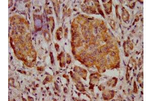IHC image of ABIN7159545 diluted at 1:400 and staining in paraffin-embedded human pancreatic cancer performed on a Leica BondTM system. (MT3 anticorps  (AA 1-68))