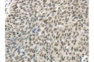 The image on the left is immunohistochemistry of paraffin-embedded Human lung cancer tissue using ABIN7131308(TBL1Y Antibody) at dilution 1/20, on the right is treated with fusion protein. (TBL1Y anticorps)