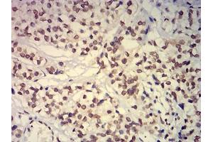 Immunohistochemical analysis of paraffin-embedded bladder cancer tissues using EHMT2 mouse mAb with DAB staining. (EHMT2 anticorps  (AA 317-471))