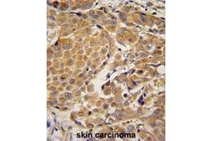 AWAT2 Antibody (C-term) immunohistochemistry analysis in formalin fixed and paraffin embedded human skin carcinoma followed by peroxidase conjugation of the secondary antibody and DAB staining. (AWAT2 anticorps  (C-Term))