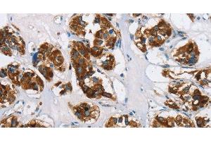 Immunohistochemistry of paraffin-embedded Human thyroid cancer using HINT2 Polyclonal Antibody at dilution of 1:50