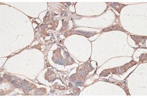 Immunohistochemistry of paraffin-embedded Human breast cancer using LAMC1 Polyclonal Antibody at dilution of 1:100 (40x lens). (Laminin gamma 1 anticorps)
