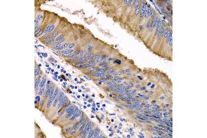 Immunohistochemistry of paraffin-embedded human colon cancer using IL9 antibody (ABIN5974970) at dilution of 1/200 (40x lens).