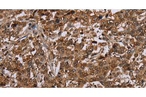 Immunohistochemistry of paraffin-embedded Human liver cancer using TBX5 Polyclonal Antibody at dilution of 1:35 (T-Box 5 anticorps)