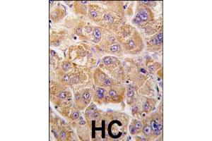 Formalin-fixed and paraffin-embedded human hepatocellular carcinoma reacted with IDE polyclonal antibody  , which was peroxidase-conjugated to the secondary antibody, followed by DAB staining. (IDE anticorps  (Internal Region))
