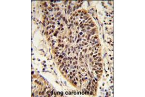 Formalin-fixed and paraffin-embedded human lung carcinoma reacted with XPA Antibody , which was peroxidase-conjugated to the secondary antibody, followed by DAB staining. (XPA anticorps  (C-Term))