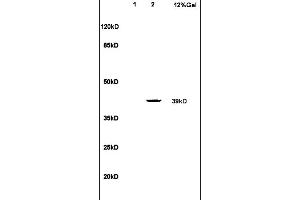 Formalin-fixed and paraffin embedded human endometrial carcinoma tissue labeled with Anti LTB4-R1 Polyclonal Antibody,Unconjugated (ABIN748628) at 1:100 followed by conjugation to the secondary antibody and DAB staining.