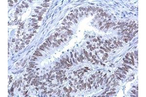IHC-P Image Rad54 antibody [C3], C-term detects Rad54 protein at nucleus on human endometrial carcinoma by immunohistochemical analysis.