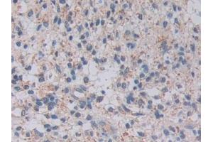 Detection of TOP3 in Human Glioma Tissue using Polyclonal Antibody to Topoisomerase III (TOP3) (TOP3A anticorps  (AA 35-179))