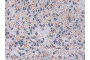 Detection of TOP3 in Human Glioma Tissue using Polyclonal Antibody to Topoisomerase III (TOP3) (TOP3 anticorps  (AA 35-179))