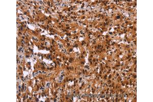 Immunohistochemistry of Human thyroid cancer using GPR124 Polyclonal Antibody at dilution of 1:40 (GPR124 anticorps)