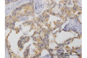 Immunoperoxidase of monoclonal antibody to NTNG2 on formalin-fixed paraffin-embedded human lung cancer.
