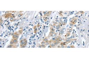 Immunohistochemistry of paraffin-embedded Human liver cancer tissue using LRP6 Polyclonal Antibody at dilution 1:60 (LRP6 anticorps)