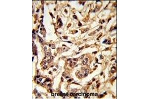 Formalin-fixed and paraffin-embedded human breast carcinoma reacted with GALT Antibody (C-term), which was peroxidase-conjugated to the secondary antibody, followed by DAB staining. (GALT anticorps  (C-Term))