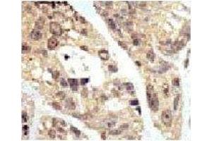 IHC analysis of FFPE human breast carcinoma tissue stained with the SUMO1 antibodyFITC-conjugated goat-anti-rabbit secondary Ab was used for the analysis. (SUMO1 anticorps  (AA 1-30))