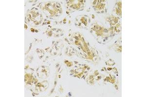 Immunohistochemistry of paraffin-embedded human breast using CASP2 Antibody (ABIN5973353) at dilution of 1/100 (40x lens). (Caspase 2 anticorps)