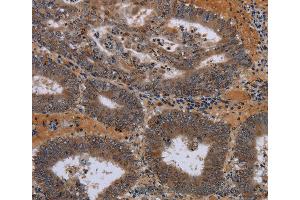Immunohistochemistry of Human colon cancer using JMJD7 Polyclonal Antibody at dilution of 1:30
