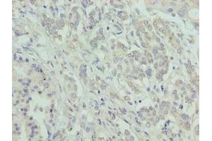 Immunohistochemistry of paraffin-embedded human pancreatic cancer using ABIN7144801 at dilution of 1:100 (ATXN7L1 anticorps  (AA 1-146))