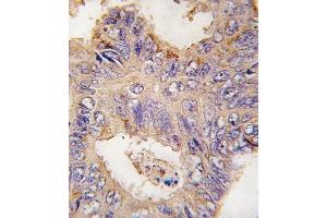 Formalin-fixed and paraffin-embedded human colon carcinoma tissue reacted with TRAF2 antibody (C-term) (ABIN392282 and ABIN2841948) , which was peroxidase-conjugated to the secondary antibody, followed by DAB staining.