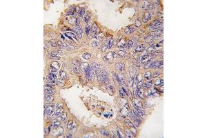 Formalin-fixed and paraffin-embedded human colon carcinoma tissue reacted with TRAF2 antibody (C-term) (ABIN392282 and ABIN2841948) , which was peroxidase-conjugated to the secondary antibody, followed by DAB staining. (TRAF2 anticorps  (C-Term))