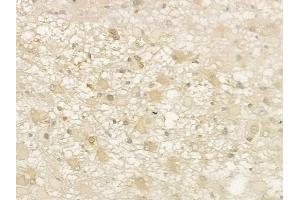 ABIN6261510 and ABIN6276759 at 1/100 staining human astrocytoma by IHC-P.