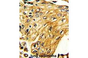 Formalin-fixed and paraffin-embedded human lung carcinoma reacted with IFNGR2 Antibody (C-term), which was peroxidase-conjugated to the secondary antibody, followed by DAB staining. (IFNGR2 anticorps  (C-Term))