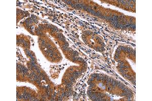 Immunohistochemistry of Human ovarian cancer using HACE1 Polyclonal Antibody at dilution of 1:50