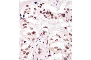 (ABIN387785 and ABIN2838022) staining SUMO1 in human breast carcinoma tissue sections by Immunohistochemistry (IHC-P - paraformaldehyde-fixed, paraffin-embedded sections). (SUMO1 anticorps)