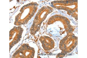 Immunohistochemistry of Human colon cancer using ACOT11 Polyclonal Antibody at dilution of 1:40 (ACOT11 anticorps)