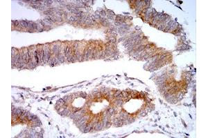 Immunohistochemical analysis of paraffin-embedded rectum cancer tissues using VIMP mouse mAb with DAB staining. (Selenoprotein S anticorps  (AA 1-187))