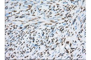 Immunohistochemical staining of paraffin-embedded liver tissue using anti-TACC3 mouse monoclonal antibody. (TACC3 anticorps)