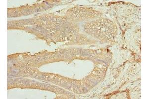 Immunohistochemistry of paraffin-embedded human endometrial cancer using ABIN7146875 at dilution of 1:100