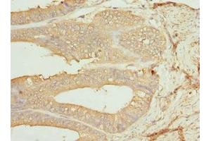 Immunohistochemistry of paraffin-embedded human endometrial cancer using ABIN7146875 at dilution of 1:100 (CSNK1G1 anticorps  (Isoform gamma 1))