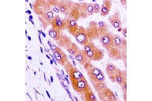 Immunohistochemical analysis of GAS2 staining in human liver cancer formalin fixed paraffin embedded tissue section.