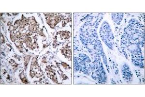 Immunohistochemistry analysis of paraffin-embedded human breast carcinoma, using BAD (Phospho-Ser155) Antibody. (BAD anticorps  (pSer118))