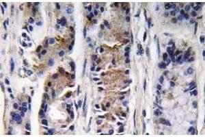 Immunohistochemistry (IHC) analyzes of Pepsin C antibody in paraffin-embedded human lung carcinoma tissue. (PGC anticorps)