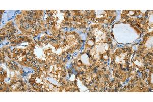 Immunohistochemistry of paraffin-embedded Human thyroid cancer using ANXA3 Polyclonal Antibody at dilution of 1:35
