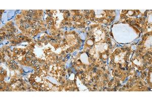 Immunohistochemistry of paraffin-embedded Human thyroid cancer using ANXA3 Polyclonal Antibody at dilution of 1:35 (Annexin A3 anticorps)