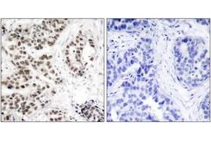 Immunohistochemistry analysis of paraffin-embedded human lung carcinoma, using Chk2 (Phospho-Thr68) Antibody. (CHEK2 anticorps  (pThr68))