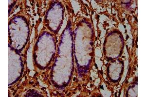 IHC image of ABIN7165044 diluted at 1:600 and staining in paraffin-embedded human gastric cancer performed on a Leica BondTM system. (AMN anticorps  (AA 25-163))