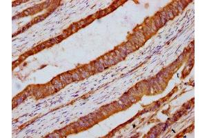 IHC image of ABIN7165653 diluted at 1:300 and staining in paraffin-embedded human colon cancer performed on a Leica BondTM system.