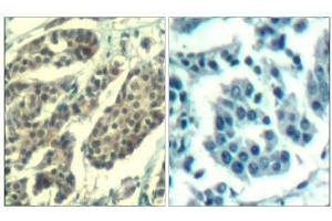 Immunohistochemical analysis of paraffin-embedded human breast carcinoma tissue using Cyclin B1 (phospho-Ser147) Antibody (E011540). (Cyclin B1 anticorps  (pSer147))