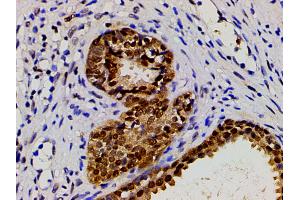 ABIN6267443 at 1/200 staining human myosarcoma tissue sections by IHC-P.
