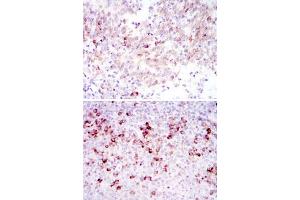 Immunohistochemical analysis of paraffin-embedded human cervical cancer tissues (upper) and tonsil tissues (bottom) using CTTN monoclonal antibody, clone 4C6  with DAB staining.