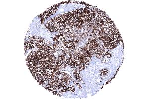 Invasive urothelial carcinoma of the kidney pelvis with strong Upk1a positivity